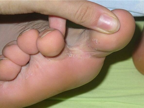 príznaky plesne nechtov na nohách