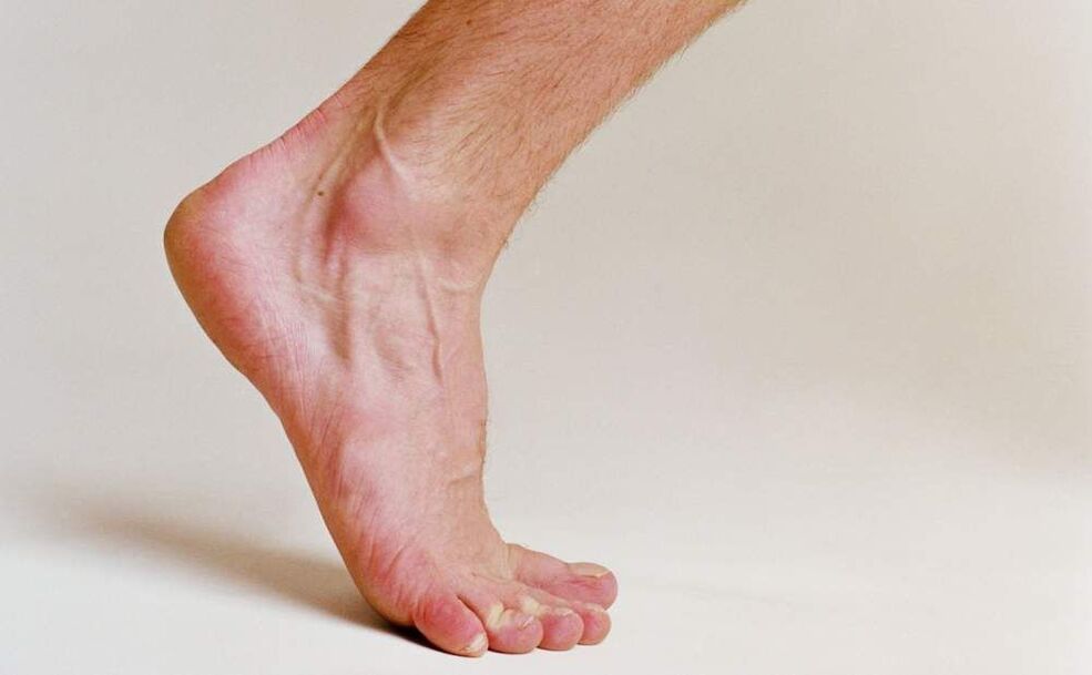 príznaky plesní na nohách