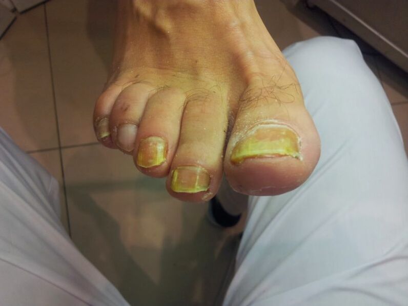 žlté nechty na nohách s plesňou