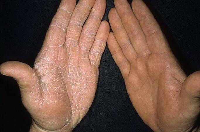 príznaky huby na koži rúk
