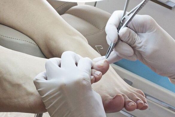 Mechanické odstránenie nechtov na nohách postihnutých plesňou