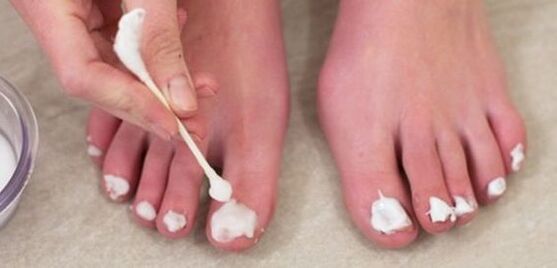 ošetrenie huby nechtov na nohách masťou