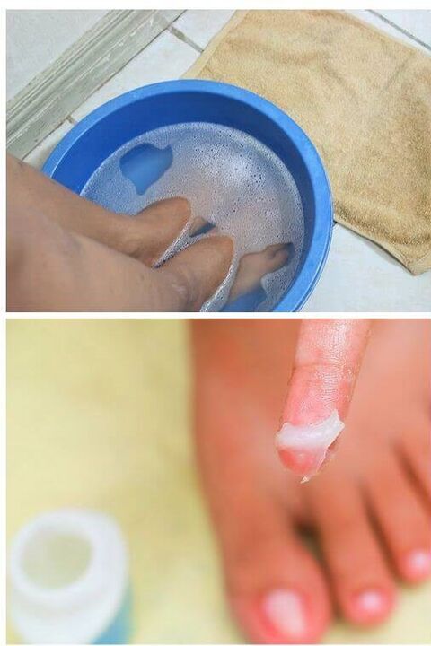 použitie prírodných olejov pri liečbe plesní nechtov na nohách