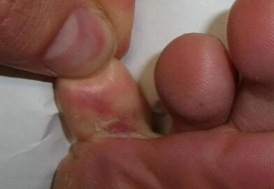 prasklina na palci na nohe je dôsledkom plesňovej infekcie