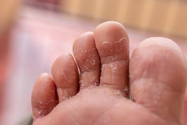 príznaky plesňových infekcií prstov na nohách